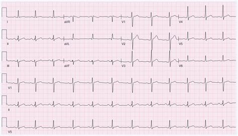 abnormal ekg blockage.